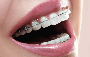 What Are the Different Types of Braces?